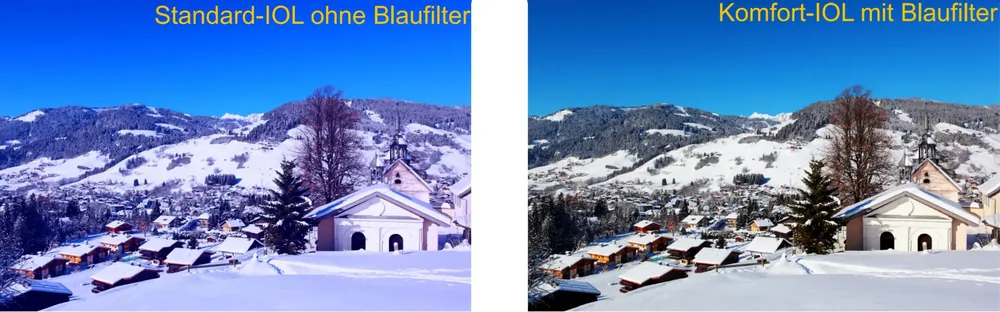 Vergleich Standard-IOL ohne Blaufilter und Komfort-IOL mit Blaufilter