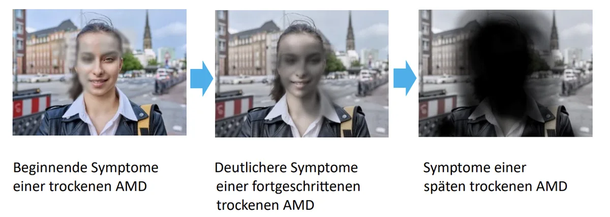Verlauf der trockenen AMD: Von beginnenden Symptomen über fortgeschrittene bis zur späten trockenen AMD