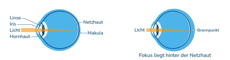 Schematische Darstellung eines normalen Auges und eines weitsichtigen Auges. Fokus liegt hinter der Netzhaut