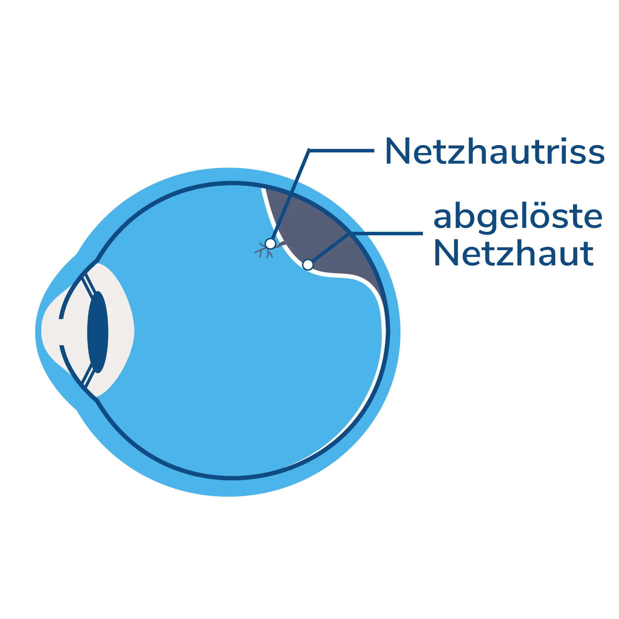Schematische Darstellung eines Netzhautrisses und einer abgelösten Netzhaut