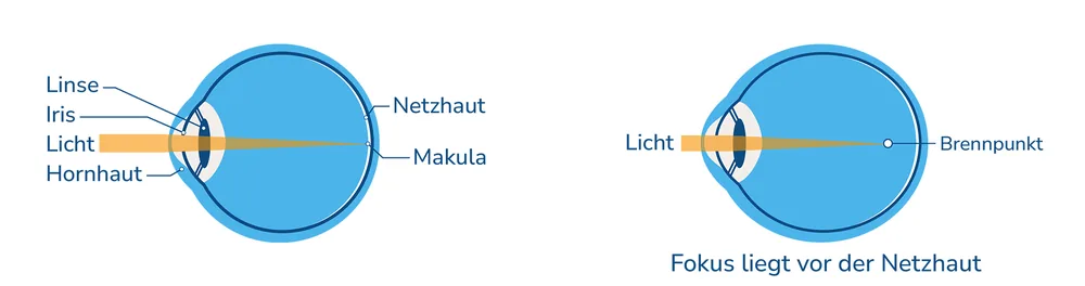 Schematische Darstellung eines normalen Auges und eines kurzsichtigen Auges. Fokus liegt vor der Netzhaut