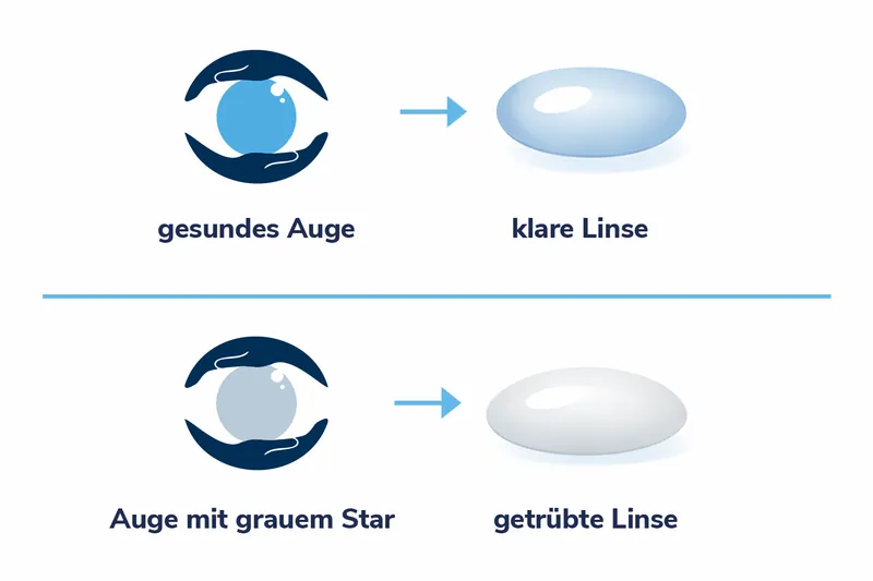 Vergleich: Gesundes Auge und Auge mit Grauem Star (Katarakt)