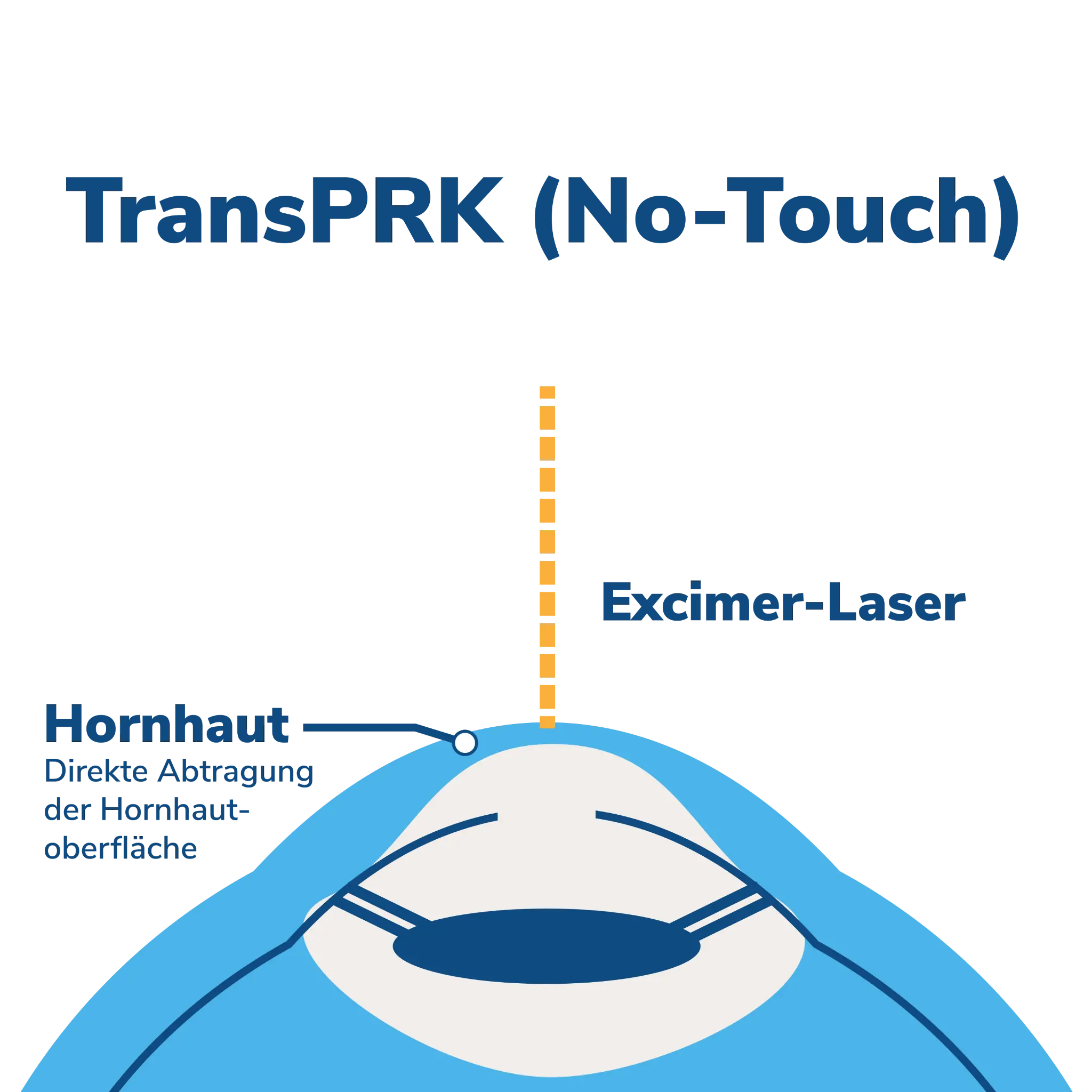 TransPRK (No-Touch)