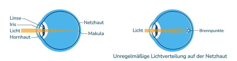 Schematische Darstellung eines normalen Auges und eines Auges mit Hornhautverkrümmung. Unregelmäßige Lichtverteilung auf der Netzhaut